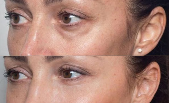 Juvelook Before and After: Real Results, Timeline, and What Truly Changes Over Time 2 juvelook-skin-booster