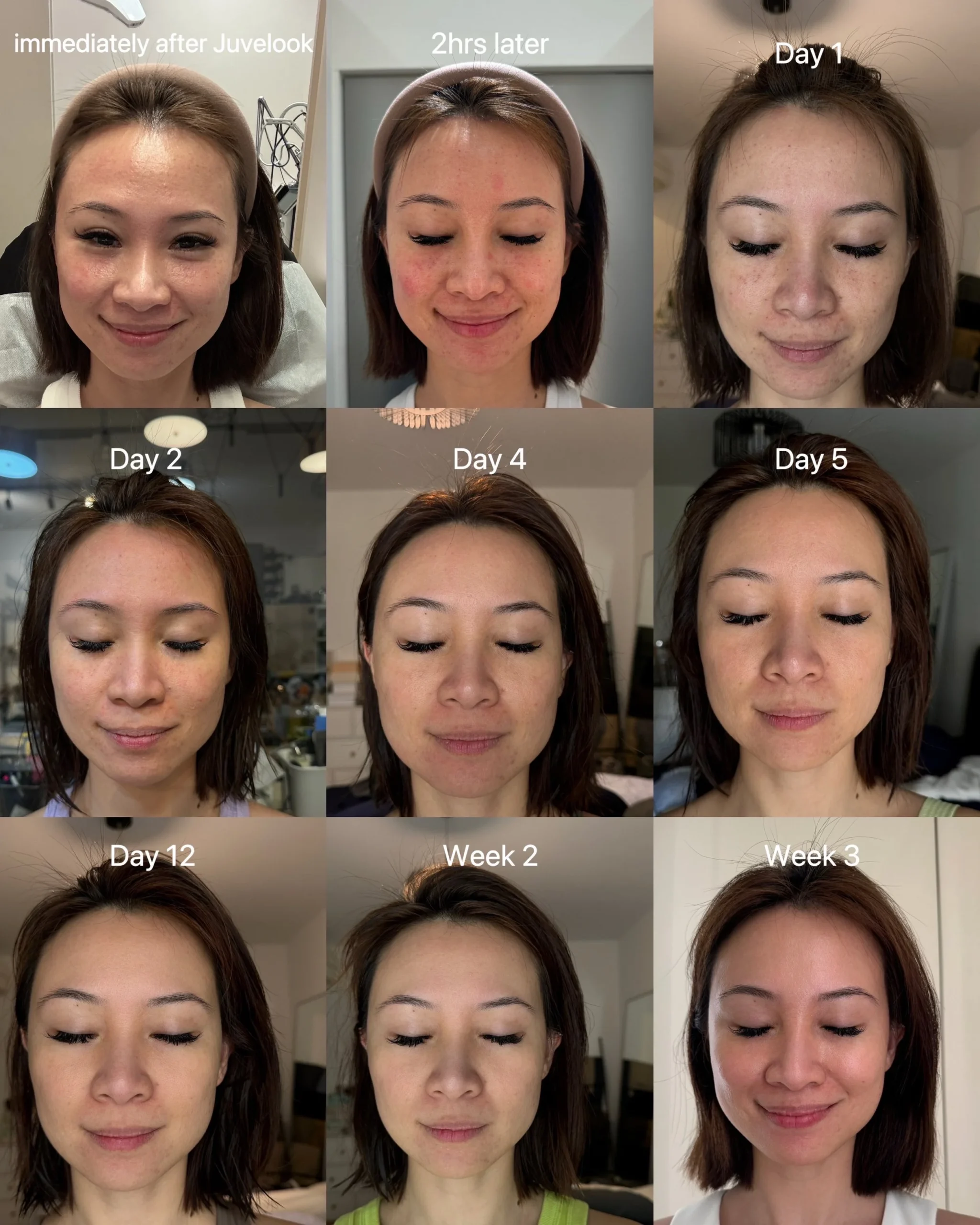 Juvelook Volume: The Natural, Long-Lasting Solution for Facial Volume Loss 3 juvelookskinboosterreviews singaporereviews cliffordaesthetics scaled